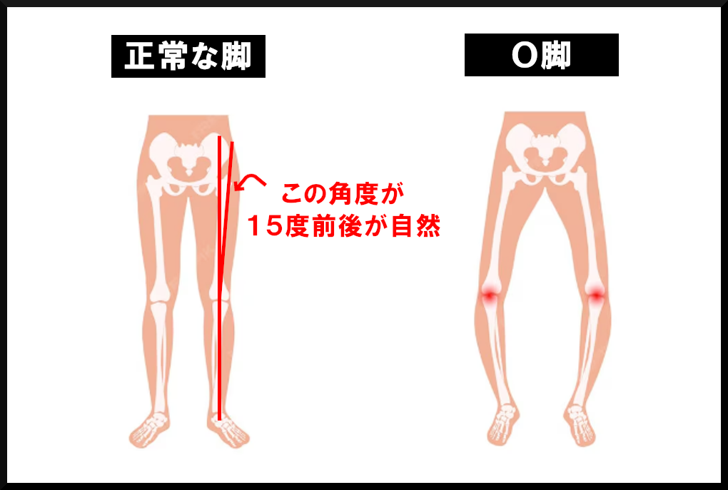 O脚の基準